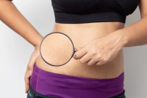 24 dicas para prevenção e tratamento das estrias